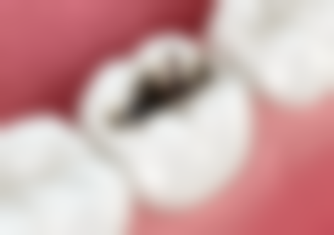 60岁以上老人种植牙值不值