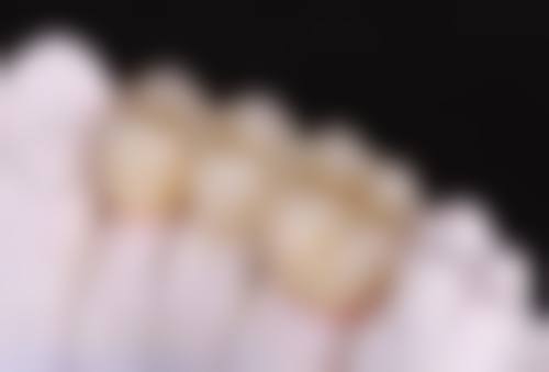 种植牙和镶牙哪种更适合多颗牙缺失?