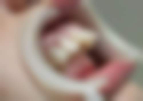 威兰德全瓷牙适合哪些人？