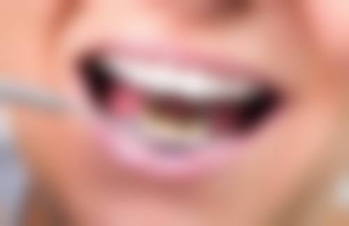 全瓷牙和纯钛牙在不同口腔环境下哪个更结实
