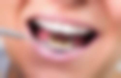 树脂补牙材料怎么样?